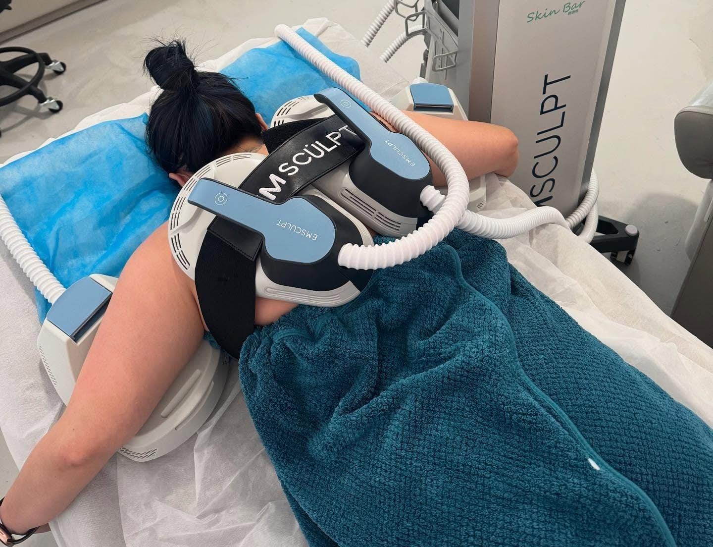 EM Sculpt before and after results at SkinBar Singapore
